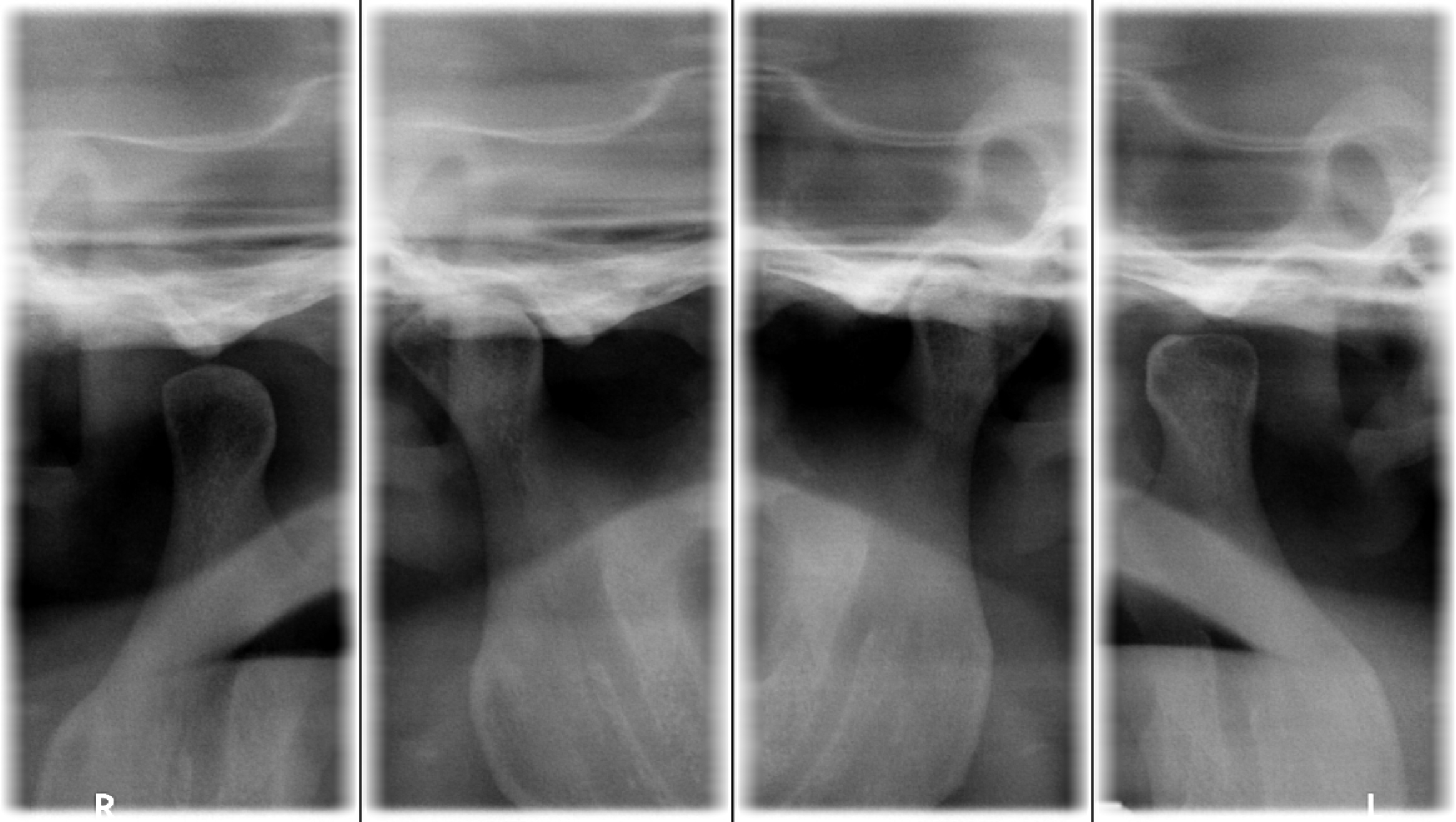 Das Panorama-Röntgenbild der Kiefergelenke zeigt den Zustand der Kieferköpfchen (Condylen) und der Gelenkpfannen (Fossae)