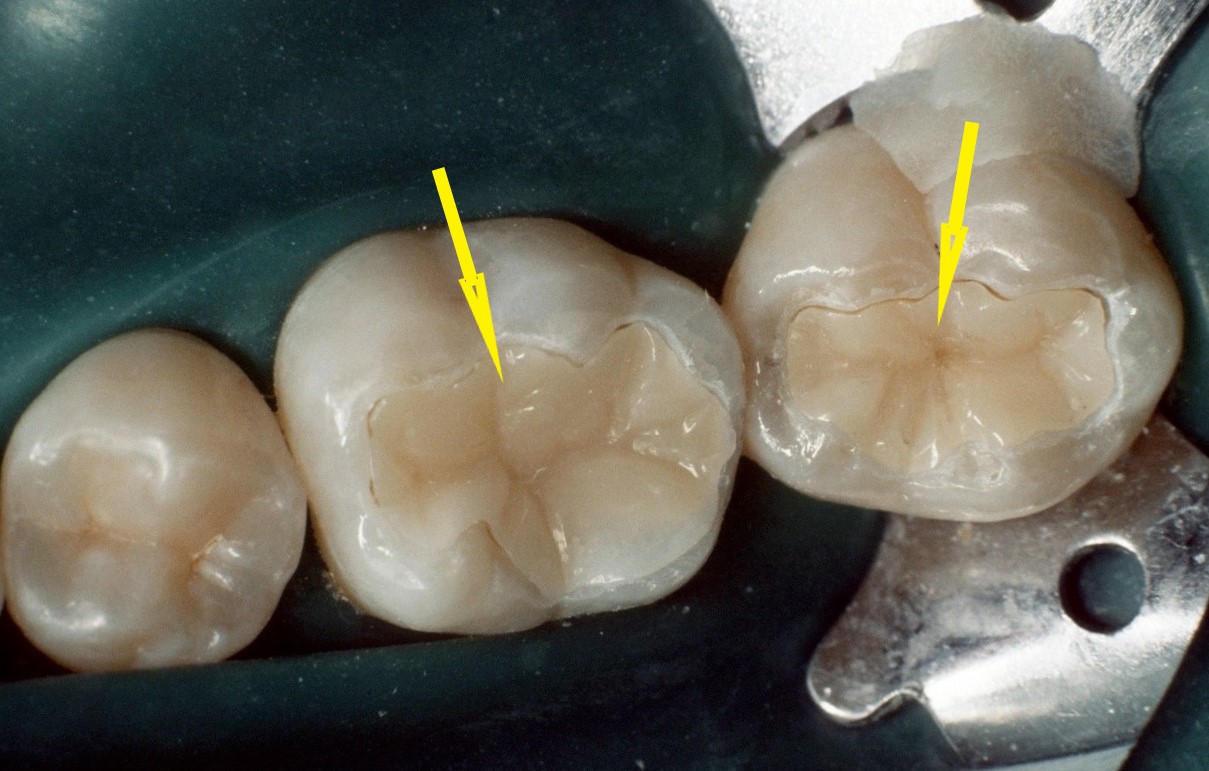 Keramische Zahnfüllungen (Keramik Inlays) bei der Einprobe