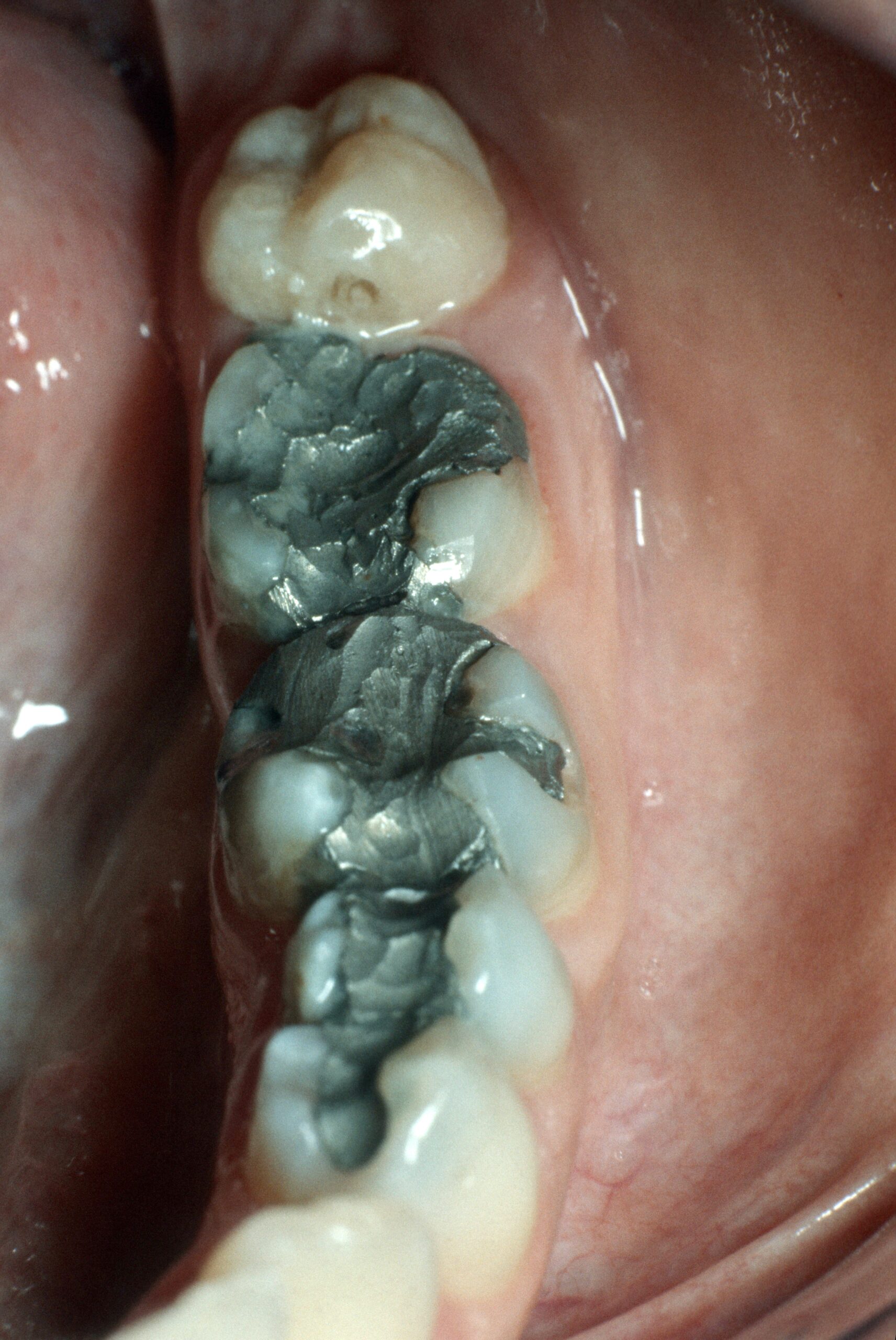 Schlecht verarbeitetes Amalgam korrodiert schneller und sondert Quecksilber in die Mundhöhle ab, welches beim Kauen verschluckt wird